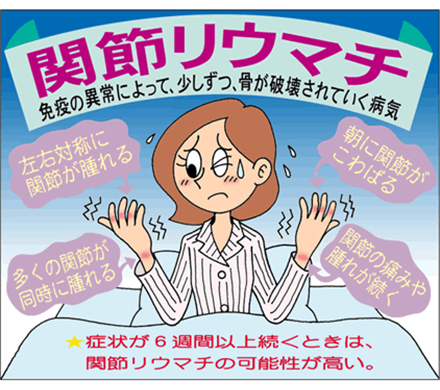リウマチ 症状 関節 関節リウマチの初期症状チェック 検査・診断を行い早期発見